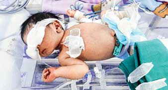 ঝুঁকির অস্ত্রোপচারে জীবন ফিরে পেল দু’দিনের শিশু