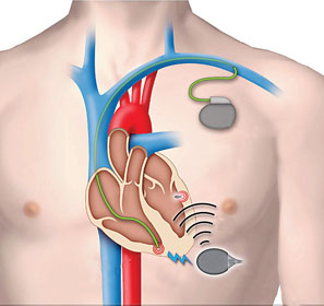 হ্যাক হতে পারে হৃদয়ের যন্ত্রও, আশঙ্কা  