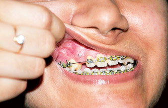 দাঁত সারাতে গিয়ে বিপাকে তরুণী, মামলা চিকিৎসাকেন্দ্রের বিরুদ্ধে