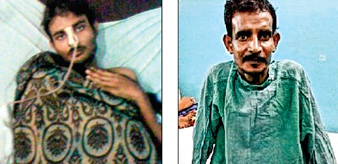 পরিবার থেকেও ছড়ায় কোলন ক্যানসার, মত চিকিৎসকদের