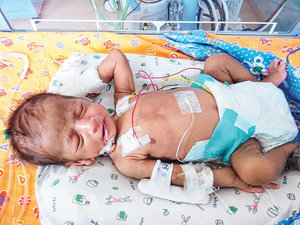 বিরল অস্ত্রোপচারে বাঁচল শিশু