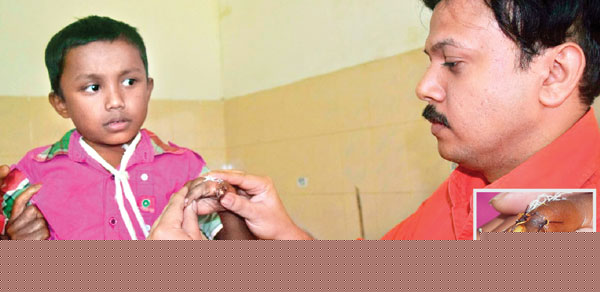 কাগজে মোড়া আঙুল জুড়লেন চিকিৎসকেরা