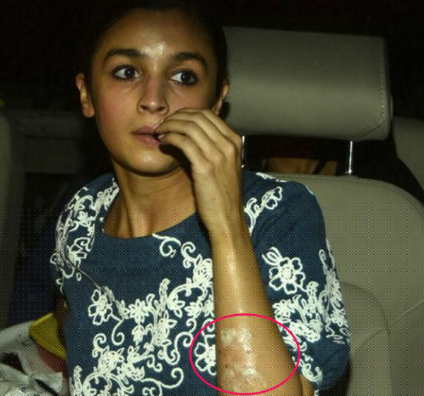 Alia Bhatt suffers burn injury during performance dgtl