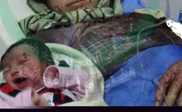 Syrian baby born with shrapnel in head