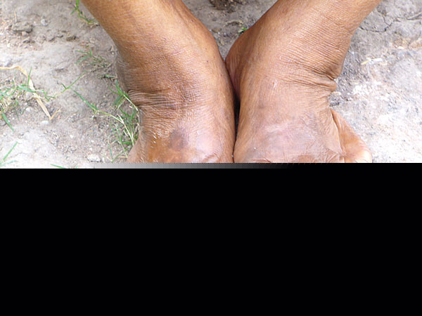 Again Leprosy starts affecting people