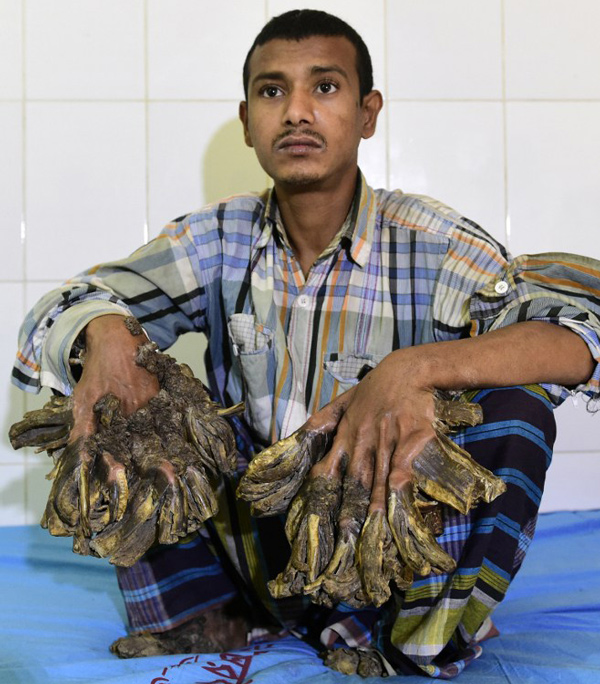 Bangladesh's 'Tree Man' To Remove Warts dgtl