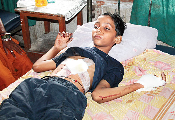 Boy injured in a mobile blast 