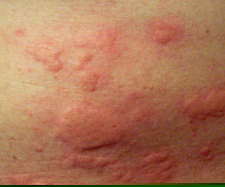 ডেঙ্গির সংক্রমণ হলে রক্তে অনুচক্রিকা বা প্লেটলেট কাউন্ট কমে যেতে শুরু করে। আর এই কারণে শরীরের বিভিন্ন অংশে হেমারেজ <br> অর্থাৎ রক্তক্ষরণ হয়। এর ফলে মশা কামড়ানোর মত লাল লাল র‍্যাশ দেখা যায়। অথবা মাড়ি, নাক বা প্রস্রাবের সঙ্গে রক্ত বেরোতে পারে।