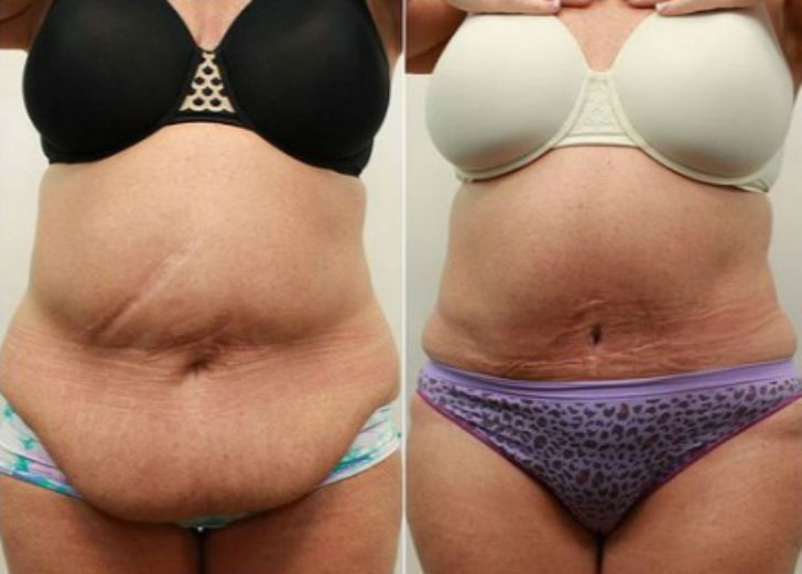 মাম্মি মেকওভার: <br> 
অস্ট্রেলীয় মা’দের মধ্যে অন্যতম জনপ্রিয় এই ধরনের মেকওভার। সন্তান হওয়ার পর অনেক সময়ই মায়ের শারীরিক <br> সৌন্দর্য নষ্ট হয়ে যায়। শরীর ভারি হয়ে যায়। পোস্ট ডেলিভারি সার্জারিতে <br> ফিরিয়ে দেওয়া যায় আগের লুক। এই প্যাকেজে থাকে ব্রেস্ট ইমপ্ল্যান্টস অ্যান্ড লিফ্ট, লাইপোস্কাল্পচার। <br> অস্ট্রেলিয়ার জনপ্রিয় কসমেটিক সার্জেন কুরোস তাভাকোলি জানাচ্ছেন, “অনেকেই এই সার্জারি করেন, কিন্তু নতুন কিছু <br> পাওয়ার দাবি করেন না। আগে তাঁরা যেমন ছিলেন তেমন অবস্থাতেই ফিরে যেতে চান।”