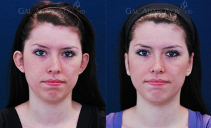 বসানো কান: <br> 
মুখের দু’পাশ থেকে উঁকি মারা কুলোর মতো কান একেবারেই না-পসন্দ হলে ‘ইয়ার কারেকশন’ সার্জারি করাতে পারেন। <br> ব্রিটেনে এই ধরনের সার্জারির চল খুব বেশি।