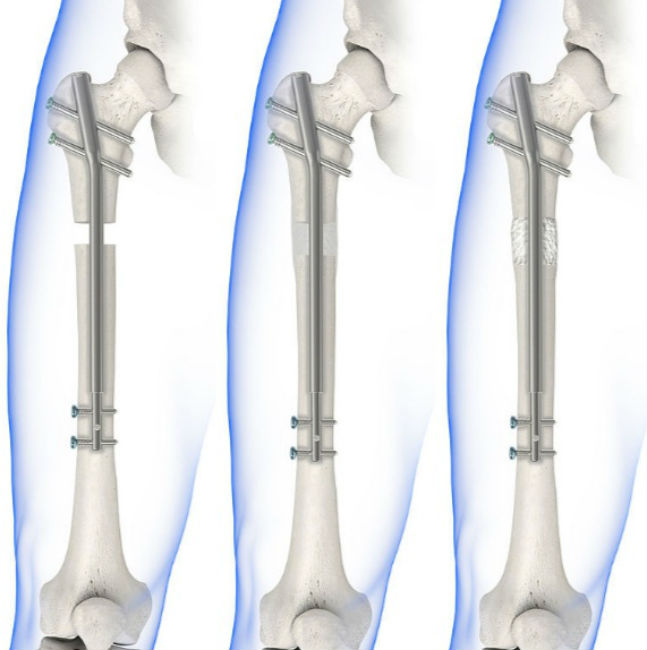লম্বা পা: <br> 
উচ্চতায় খাটো হতে কে-ই বা চায়? কিন্তু নিতান্তই যদি কারও উচ্চতা মন মতো না হয় তা হলেও চিন্তার কিছু নেই। <br> হাতের কাছেই রয়েছে লিম্ব লেন্থনিং সার্জারি। এ ধরনের আস্ত্রোপচার <br> আবার সবচেয়ে জনপ্রিয় ভারতে। পায়ের হাড় কেটে তার মাঝখানে কৃত্রিম হাড় ঢুকিয়ে জুড়ে দিলেই <br> উচ্চতা বেশ খানিকটা বেড়ে যাবে। এই ভাবে তিন ইঞ্চি পর্যন্ত লম্বা হতে পারবেন আপনি।