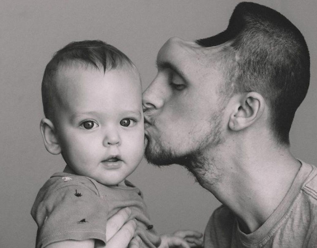 চিকিৎসকেরা জানান, কাজের সময় নিজেকে চাপমুক্ত রাখতে অত্যধিক এনার্জি ড্রিঙ্ক খেতেন অস্টিন। অত্যধিক টক্সিন খেয়ে তাঁর মস্তিষ্কে ক্ষতের সৃষ্টি হয়। ছিদ্র হয়ে যায় খুলিতে। দ্রুত অস্ত্রোপচারের প্রয়োজন। টানা ৫ ঘণ্টা ধরে কঠিন অস্ত্রোপচার হয় অস্টিনের মস্তিষ্কের।