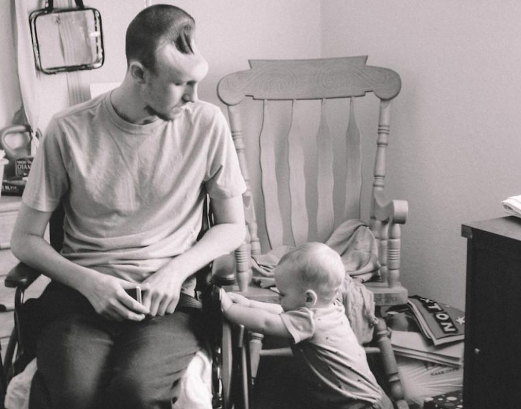 আর তাতেই তাঁর খুলিতে ফাঁক থেকে যায়। অস্টিনের কপালের পর থেকে মাথার অর্ধেকটার খুলিই নেই। কপাল থেকে মাথার অর্ধেকটা বসে গিয়ে অদ্ভুত দেখতে হয়ে যায় অস্টিনকে। অসুস্থতার কারণে শয্যাশায়ী হয়ে পড়েন তিনি।