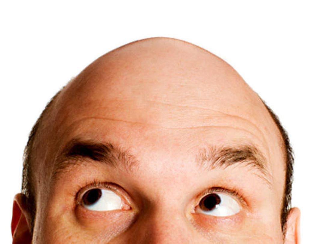 পেলাডোফোবিয়া: জীবনের কোনও অপ্রীতিকর অভিজ্ঞতার জন্য এমনটা হয়ে থাকে। এই ফোবিয়া যাদের থাকে তারা টাক মানুষ দেখলেই ভয় পান। কখনও সখনও নিজেদের মাথায় টাক পড়ে যাওয়ার ভয়তেও ভোগেন।