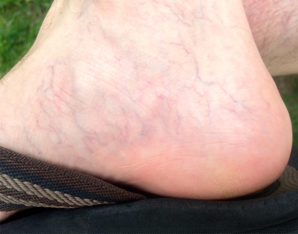 যদি আপনার প্রায়শই পা ক্রস করে বসার অভ্যাস থাকে তা হলে শিরায় চাপ পড়তে পড়তে রক্ত জমাট বেঁধে স্পাইডার ভেনের সমস্যা হতে পারে।