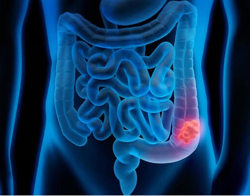 কোলন ক্যানসার: স্মোকিং বা সল্টিং পদ্ধতিতে প্রসেসড মিট প্রিজার্ভ করা হয়। যা শরীরে কার্সিনোজেন তৈরি করে। যা কোলোরেক্টাল বা বাওয়েল ক্যানসার ডেকে আনতে পারে।