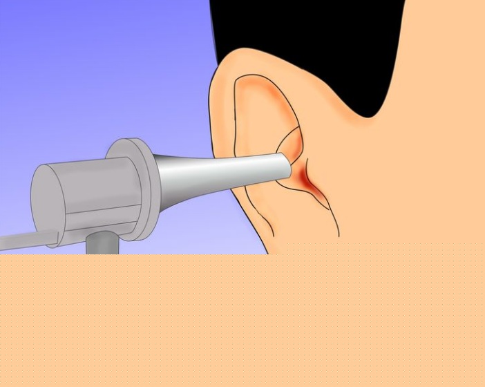 কানের খোল যদি সাদা রংয়ের হয় তবে বুঝতে হবে আপনার শরীরে আয়রনের ঘাটতি রয়েছে।