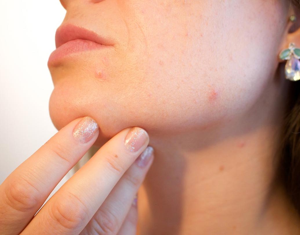 ত্বকের সমস্যা: দীর্ঘ অবসাদের কারণে অনেকেই শুষ্ক ত্বক, অ্যাকনে, চুল পড়ে যাওয়ার সমস্যায় ভোগেন।