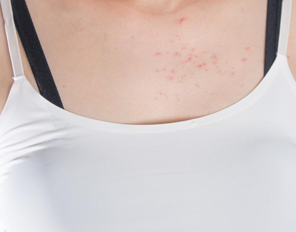 বিকিনি ওয়াক্স বা শেভ করার ফলে যে কোনও রকম ভাইরাল ইনফেকশন সংক্রমণের ঝুঁকি বাড়ে। ঝুঁকি বাড়ে যৌন রোগ সংক্রমণেরও। ফলে যৌনাঙ্গে ছবির মতো লাল র‌্যাশ দেখা দেয়।