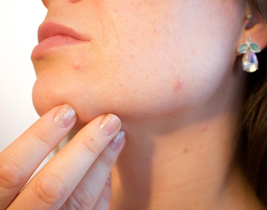 ত্বকের যত্ন: তেলতেলে ত্বক এবং ব্রণের সমস্যা দূর করতে পেঁপে বীজ দিয়ে বানিয়ে ফেলুন ঘরোয়া মিশ্রণ। পেঁপে বীজ এবং পাতা বেটে ফেস প্যাক বানিয়ে মুখে লাগিয়ে রাখুন ১০ মিনিট। ত্বকের হারানো ঔজ্জ্বল্য ফিরে আসবে।