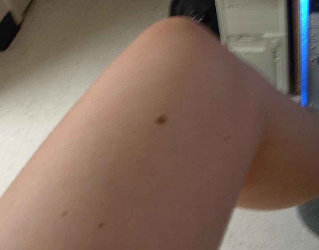 বাম হাঁটুতে তিল:সঞ্চয় করার অনেক চেষ্টা করবেন আপনি। কিন্তু অর্থকষ্টে ভুগতে হতে পারে আপনাকেও।