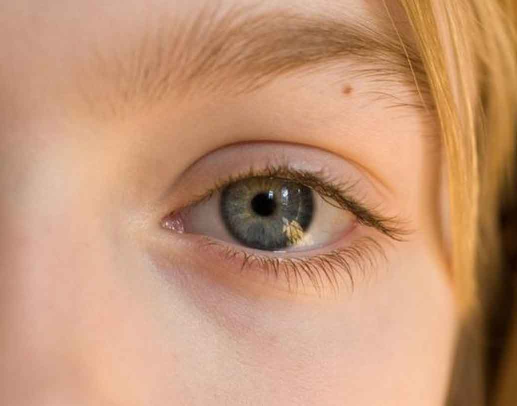 ভ্রূ-তে তিল:ভ্রূয়ের মধ্যে বড় তিল অর্থকষ্টের ইঙ্গিত দেয়। এঁদের বিবাহিত জীবনও খুব একটা সুখের হয় না। বেশিরভাগ জীবনই কেটে যায় টানাপোড়েনের মধ্যে।