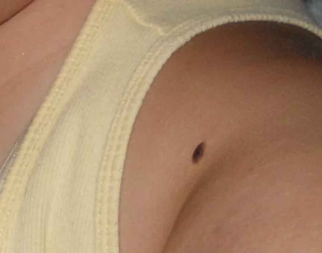 বাম বগলে তিল:বাম বগলে তিল থাকলে স্বাস্থ্য নিয়ে সচেতন থাকুন আপনি। শারীরিক সমস্যাজনিত কারণে প্রচুর টাকা খরচ হতে পারে আপনার।