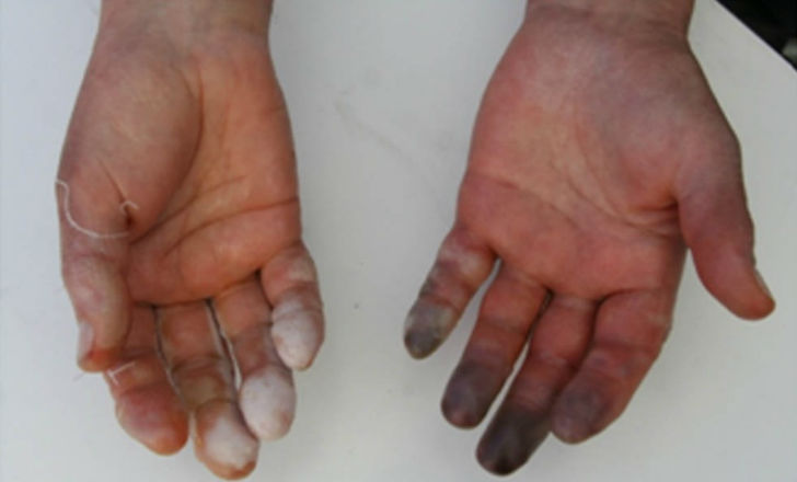 ধারণা: ফ্রস্ট বাইট বা তুষারক্ষত হলে সেই ক্ষতস্থানটি ঘষে ঘষে গরম করা উচিত। তারপরে তাতে গরম জল ঢালা উচিত। <br> 
সত্যি: খুব ধীরে ধীরে ক্ষতস্থানটি গরম করে তুলতে হয়। ঘষা বা গরম জল ঢালা একেবারেই উচিত নয়। <br> বরং কম্বল চাপা দিয়ে, গরম সেঁক দিয়ে ক্ষত স্থানটির পরিচর্যা করা উচিত।