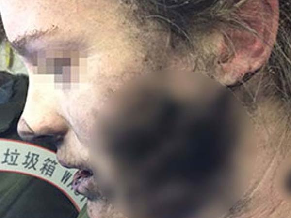 Face of a woman passenger burnt as her headphone exploded dgtl 