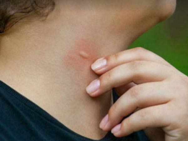 ত্বক: আপনার ত্বকে কি স্টেরয়েড বা কোলেস্টেরল বেশি মাত্রায় আছে? তা হলে মশারা বেশি আকৃষ্ট হবে। <br>তবে এমনটা ভাবার কোনও কারণ নেই যে ত্বকে কোলেস্টেরল বেশি থাকা মানেই শরীরে তা বেশি আছে।