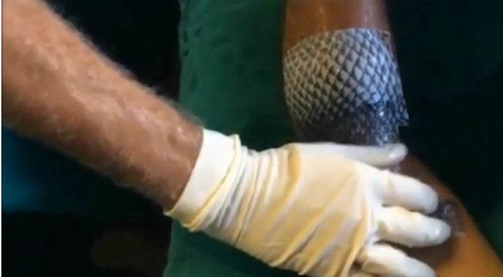 বিকল্প ছাল দিয়ে দগ্ধ অঙ্গ সারিয়ে তোলার প্রথা অনেক আগে থেকেই প্রচলিত। মানুষের চামড়ার পাশাপাশি এই কাজে কৃত্রিম চামড়া ও শুয়োরের ছালও ব্যবহার করা হয়।