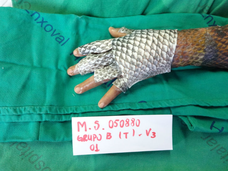 কিন্তু ব্রাজিলের মতো দেশে এই ধরনের সামগ্রীর যা যোগান তাতে দেশের মোট জনসংখ্যার মাত্র ১ শতাংশ রোগীর চিকিৎসা করা সম্ভব। তবে তেলেপিয়া এমন একটি প্রজাতির মাছ যা মোটামুটি সব জায়গাতেই কম-বেশি পাওয়া যায়। তাই এই মাছের ছাল অতি সহজপ্রাপ্ত।