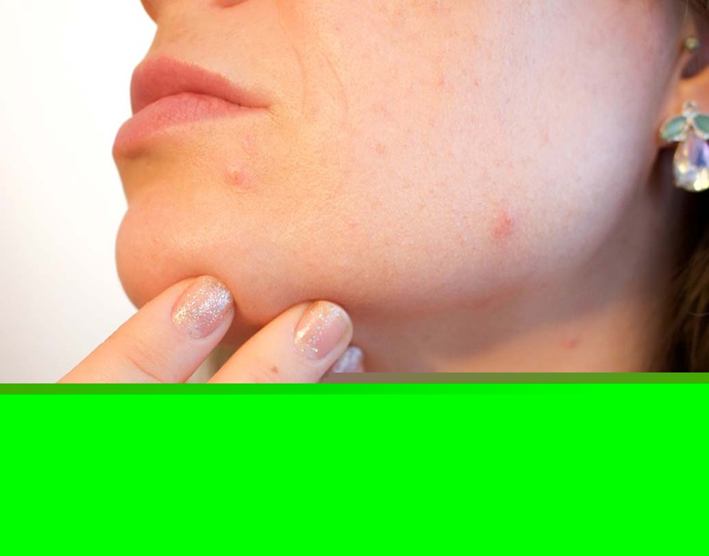 অ্যাকনে: মুখের কোথাও অ্যাকনে থাকলে তুলো মাউথওয়াশে ভিজিয়ে প্রতি দিন লাগান। কমে যাবে, দাগও মিলিয়ে যাবে।