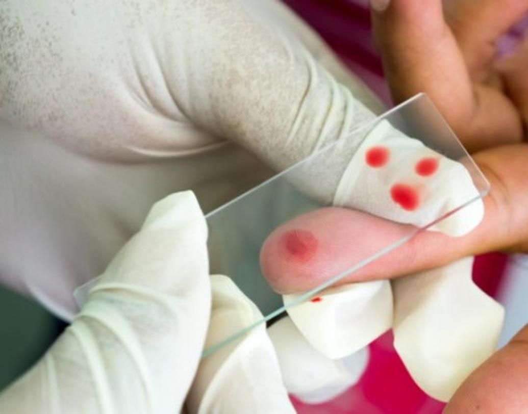 ম্যালেরিয়া: বর্ষায় সবচেয়ে বেশি যে রোগ দেখা যায় তা হল ম্যালেরিয়া। বর্ষার জমা জল থেকে মশাবাহিত রোগ ম্যালেরিয়া বাচ্চা থেকে বড় সকলেরই হতে পারে। এই ম্যালেরিয়ায় যদি ম্যালিগন্যান্ট হয়ে যায় তা থেকে মৃত্যুও হতে পারে।