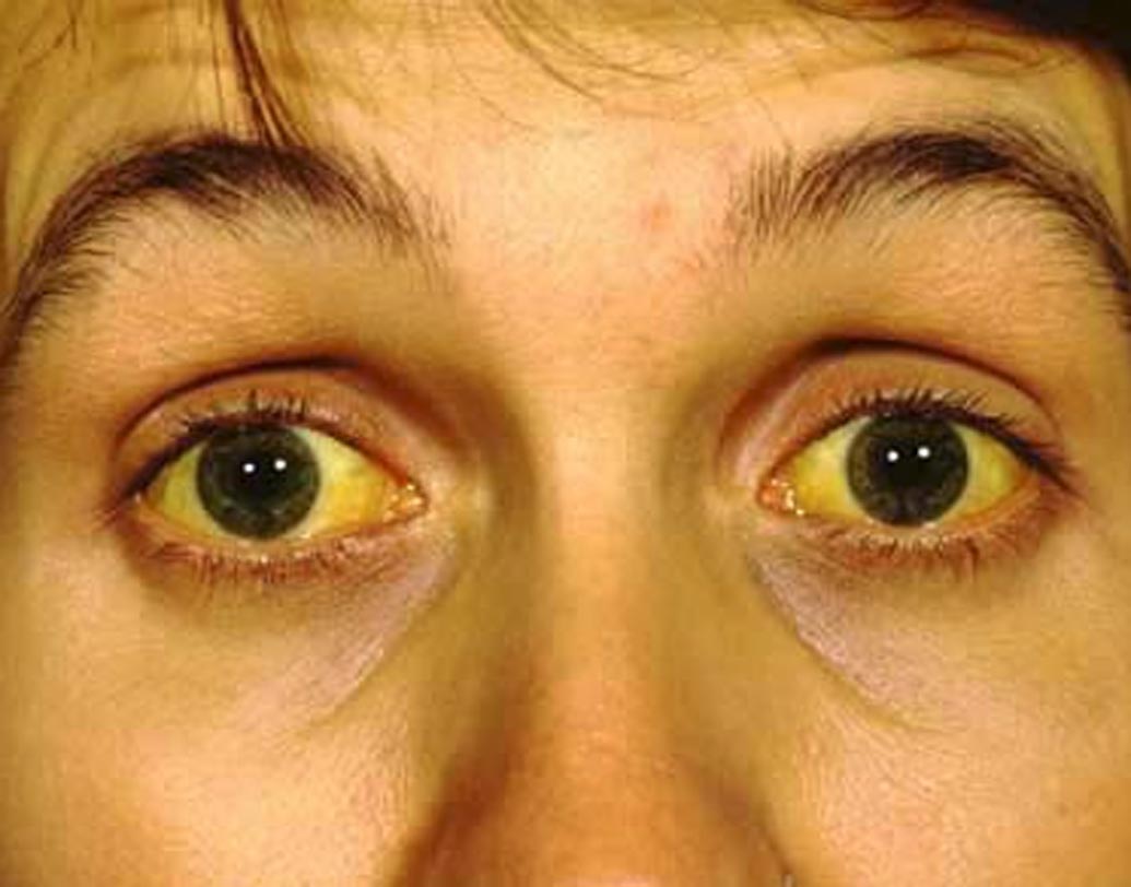 জন্ডিস: বর্ষায় অপরিশোধিত জল থেকে হেপাটাইটিস ভাইরাসের সংক্রমণ হয়। হেপাটাইটিসের সংক্রমণে রক্তের বিলিরুবিনের মাত্রে বেড়ে গিয়ে জন্ডিস দেখা দেয়। এই সময় বাইরের জল ভুলেও খাবেন না।