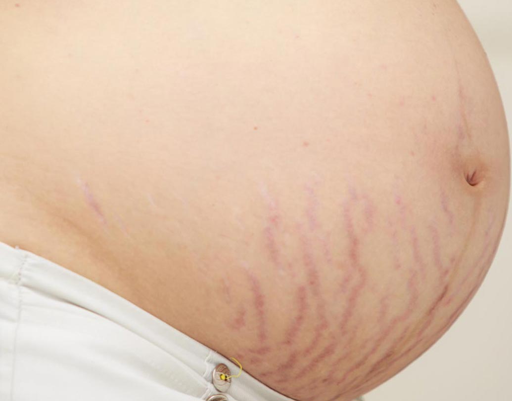 প্রসবের পর স্ট্রেচমার্কের জায়গায় লাগাতে পারেন ভিক্‌স। এটা খুবই কার্যকরী।