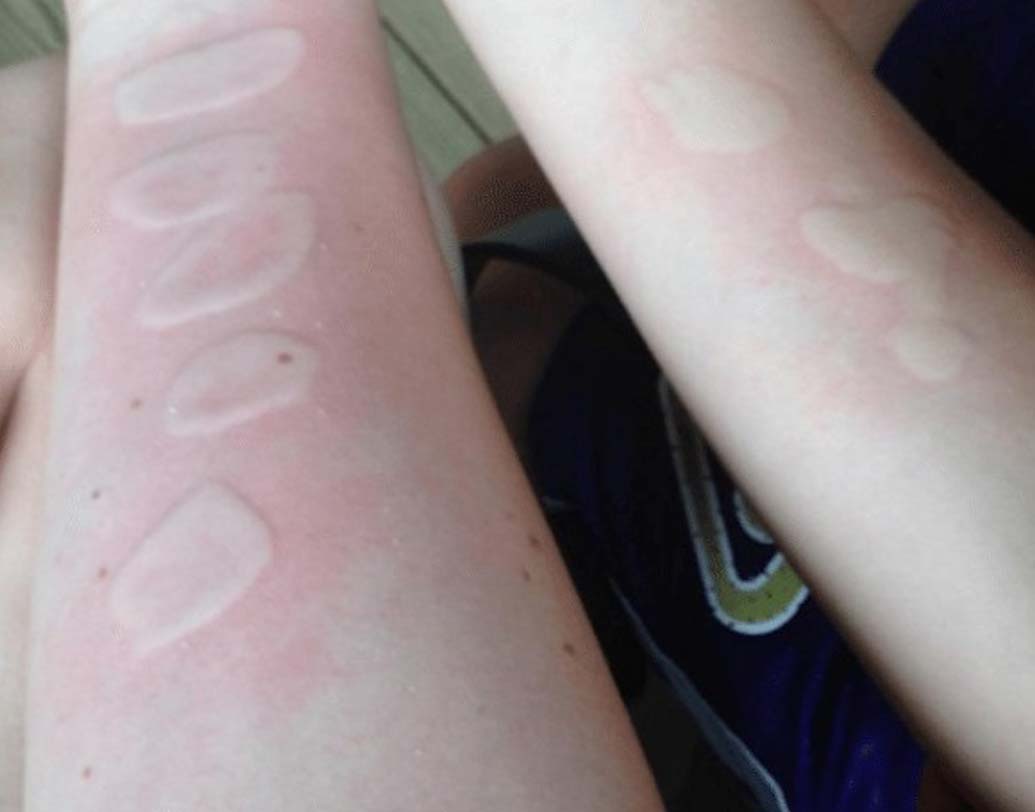 দ্য সল্ট অ্যান্ড আইস চ্যালেঞ্জ:
এই গেমে প্রথমে চামড়ার উপর নুন রাখতে হয়। তার উপর বরফ চেপে ধরতে হয়। এতে বরফের তাপমাত্রা কমে যায়। যা ত্বকের উপর ভয়ঙ্কর ক্ষতের সৃষ্টি করে। খেলায় এখনও কারও মৃত্যু হয়নি।