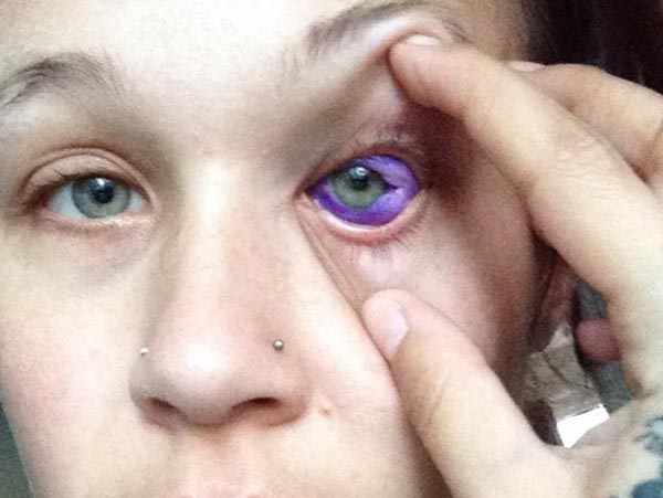 A Canadian model has been left partially blinded after having eye tattoo dgtl
