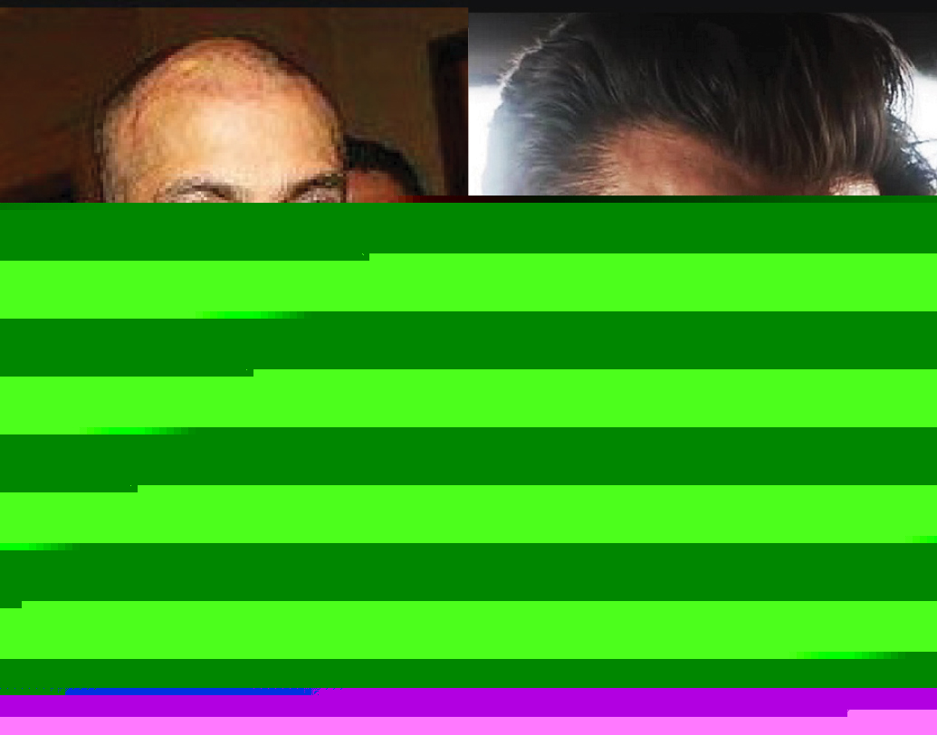 ‘সুলতান’ ছবির পর পরই নাকি হেয়ার ট্রান্সপ্লান্ট করিয়েছিলেন সলমন খান। মাথায় চুল এতটাই কমে গিয়েছিল যে, কোনওরকম নতুন লুক ট্রাই করতে পারছিলেন না অভিনেতা। সে কারণেই দুবাইয়ের এক বিশেষজ্ঞ চিকিত্সকের কাছে হেয়ার ট্রান্সপ্লান্ট করান সলমন।