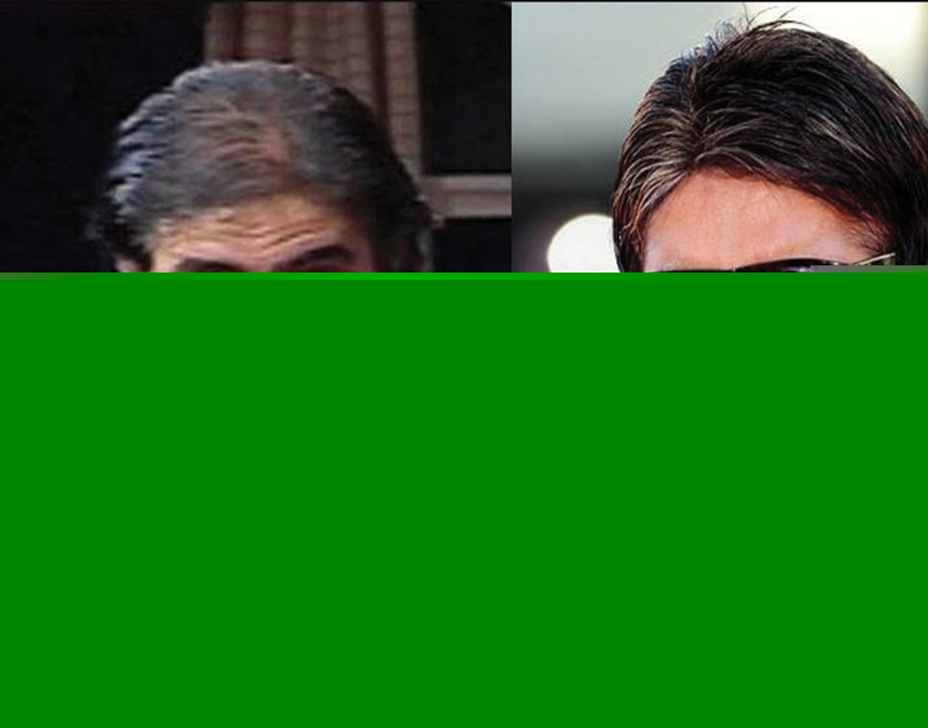 অমিতাভ বচ্চনও নাকি হেয়ার ট্রান্সপ্লান্ট করিয়েছেন। ন’-এর দশকের শেষের দিক থেকেই মাথায় চুল কমতে শুরু করেছিল বিগ বি’র। ২০০০ সালে ‘কৌন বনেগা ক্রোড়পতি’-তে কামব্যাক করেছিলেন তিনি। ইন্ডাস্ট্রি সূত্রে খবর, তার আগেই নাকি হেয়ার ট্রান্সপ্লান্ট করান অমিতাভ।