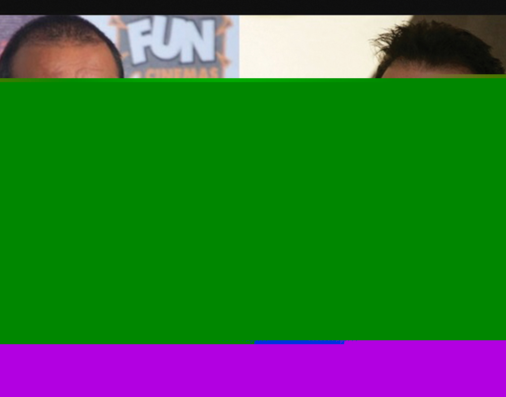 তালিকায় নাকি রয়েছেন সঞ্জয় দত্তও। ‘অগ্নিপথ’ ছবিতে একেবারে মাথা কামিয়ে ফেলার পর নাকি সঞ্জয় ‘ফলিকিউলার ইউনিট ট্রান্সপ্লান্ট’ করিয়েছিলেন। যদিও শোনা যায়, তার বহুদিন আগে থেকেই চুল পড়ার সমস্যায় ভুগছিলেন সঞ্জু বাবা।