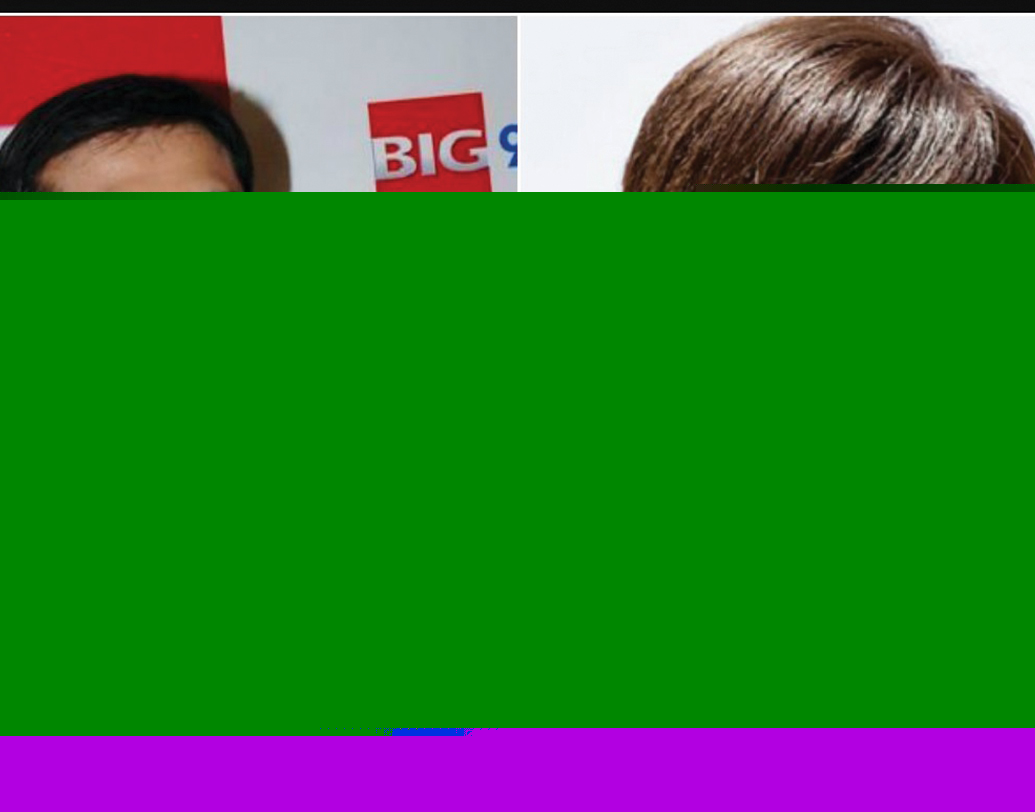 টাক ঢাকার জন্য এক সময় মাথায় টুপি ছাড়া বেরতেন না হিমেশ রেশমিয়া। কিন্তু কয়েক বছরের মধ্যেই তাঁর লুক একেবারে বদলে গিয়েছে। এখন তাঁর সুন্দর, স্মুথ ও সিল্কি চুল দেখলে যে কারও হিংসেও হতে পারে। কিন্তু ইন্ডাস্ট্রিতে জোর গুঞ্জন, এ সবই নাকি হেয়ার ট্রান্সপ্লান্টের ফল।