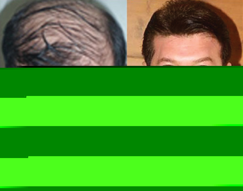 আদিত্য পাঞ্চোলির টাক মাথায় ছবি সকলেরই মনে থাকার কথা। তাঁরও ৯-এর দশকের শেষের দিকে মাথার চুল একেবারেই ফাঁকা হয়ে গিয়েছিল। কিন্তু উইগ ব্যবহার করতে নারাজ অভিনেতা, সোজা হেয়ার ট্রান্সপ্লান্টেরই সাহায্য নিয়েছিলেন। ইন্ডাস্ট্রি সূত্রে খবর, আদিত্যও নাকি দুবাইতে ট্রান্সপ্লান্ট করিয়েছিলেন।