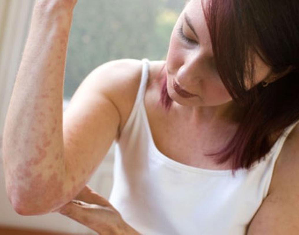 যদি আপনার ত্বকে সোরিয়াসিস বা একজিমার মতো সমস্যা থেকে থাকে তা স্ট্রেসের প্রভাবে আরও বেড়ে যায়। ফলে ত্বকের অবস্থা খারাপ হতে থাকে।