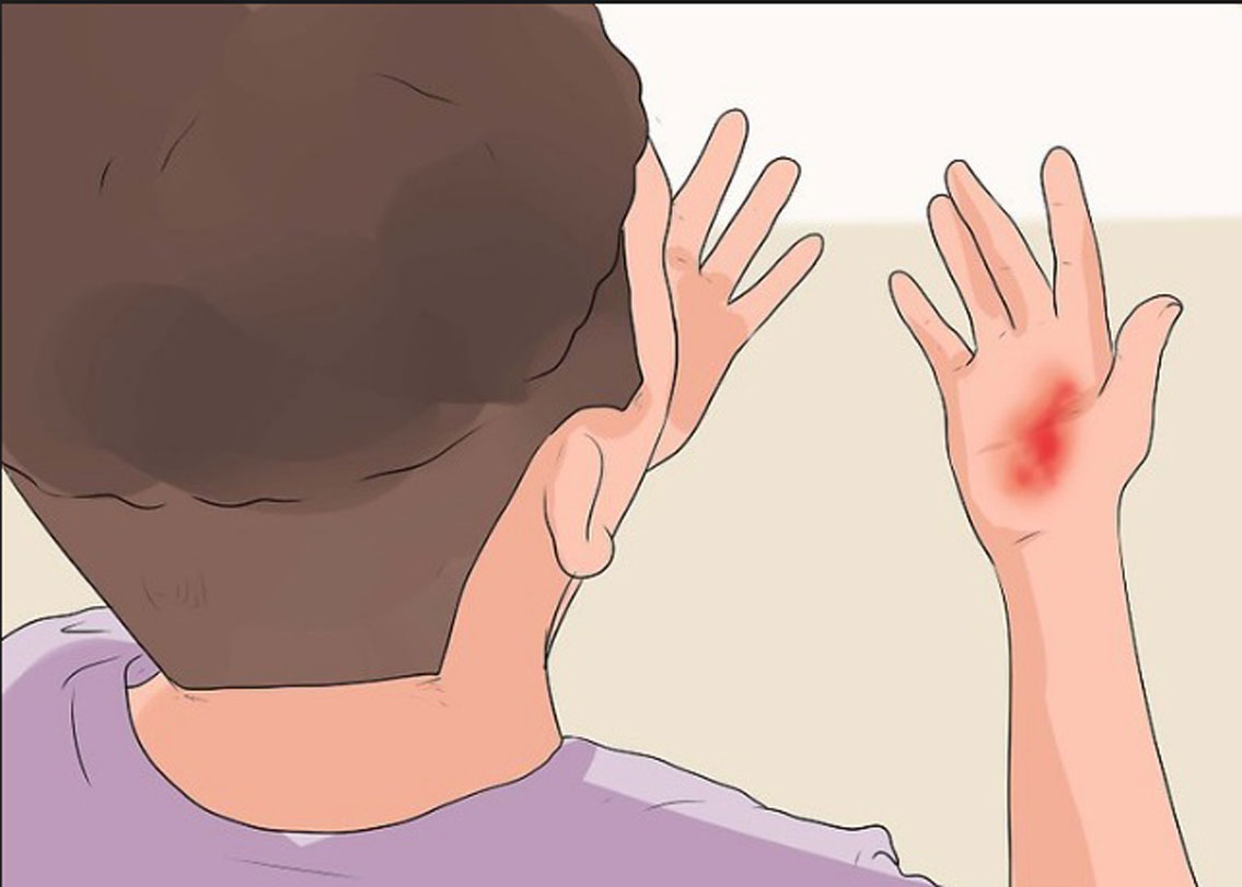 কোথাও পুড়ে গেলে তৎক্ষণাৎ তাতে মাখন বা তেল লাগিয়ে দেওয়া। এটা অনেকেই করে থাকেন। কিন্তু এটা ভুল পদ্ধতি। বরং ঠাণ্ডা জল দেওয়া উচিত।