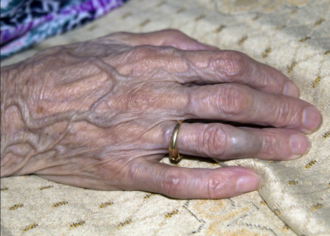 চিকিৎসকদের মতে, ত্বক কতটা পুরু তার উপর নির্ভর করে শিরা দেখা যাবে কি না। বয়সের সঙ্গে ত্বকের নীচের ফ্যাটের স্তর পাতলা হতে শুরু করে। ঠিক এই কারণে বয়স্কদের হাতে বা পায়ে বাইরে থেকে অনেক বেশি শিরা দেখা যায়।