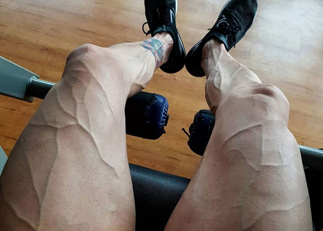 কিছু মানুষের আবার ত্বক ছোট থেকেই খুব পাতলা কিংবা তাঁদের শিরার বিন্যাস ত্বকের একেবারে উপরের দিকেই থাকে। যার জন্য তাঁদেরও শিরা বাইরে থেকে দেখা যায়।