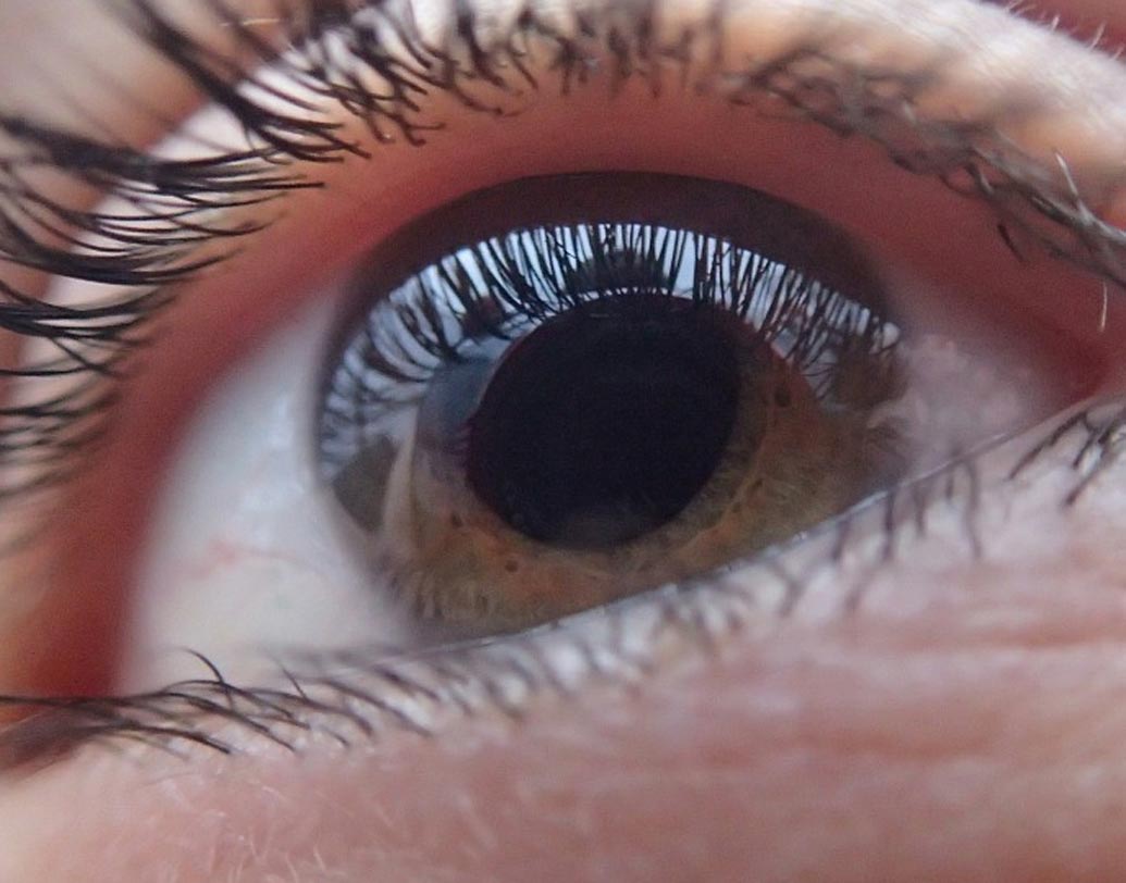 কর্নিয়ার চিকিৎসার জন্য ফিব্রিট ফিন্যান্ট, হেয়ার ট্রান্সপ্লান্টের জন্যে গ্রোথ ফ্যাক্টর ইত্যাদি ব্যবহার করলে দ্রুত কাজ হয়।