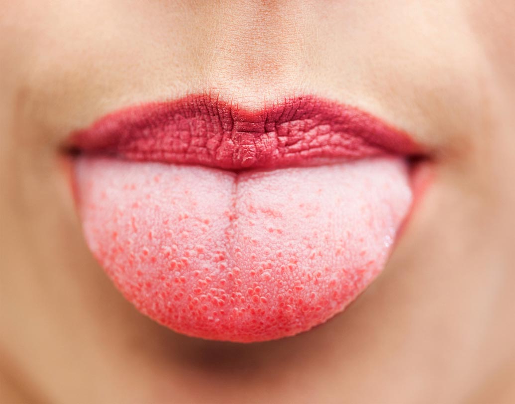 মুখের মধ্যে কোনও সাদাটে বা লালচে প্যাচ হলে চিকিৎসকের পরামর্শ নেওয়া জরুরি। বিশেষত তিনি যদি স্মোকার বা ধোঁয়াহীন তামাকে আসক্ত হন, লিউকোপ্লেকিয়া অর্থাৎ সাদাটে প্যাচ হল প্রি ক্যানসারাস স্টেজ। অর্থাৎ, এই জিনিসটা ফেলে রাখলে ভবিষ্যতে ক্যানসার হওয়ার ঝুঁকি থাকে।