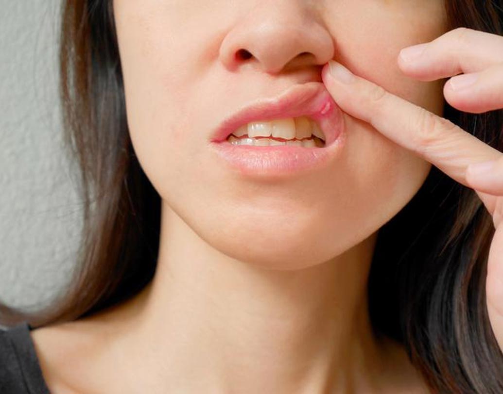ঠোঁটের ওপর কোনও ক্ষত তৈরি হয়েছে, যা ওষুধ খেয়েও সারছে না।